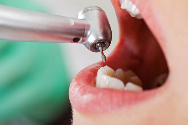 Best Emergency Dentist for Lost Fillings or Crowns in Chowchilla, CA